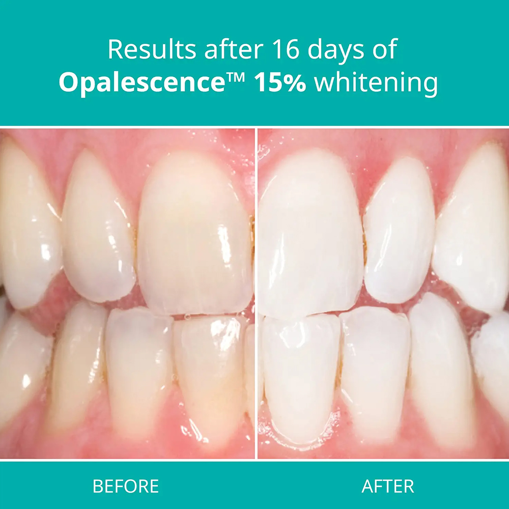 Teeth Whitening Gel Home Kit D - огляд і ціна Teeth Whitening Gel Opalescence
