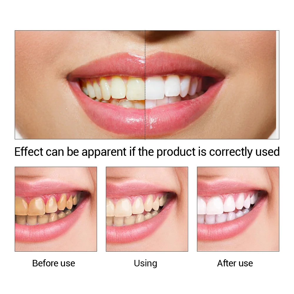 FTEENPLY Teeth Whitening Essen - огляд і ціна Teeth Whitening Instant