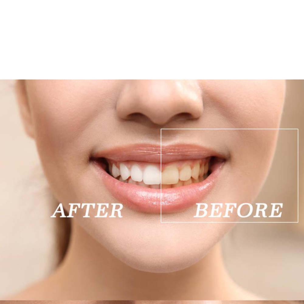 Top Quality Peroxide Teeth Whi - огляд і ціна Teeth Whitening Led Kit