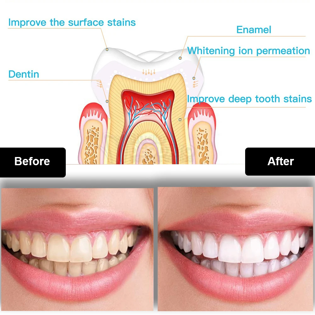Dental Teeth Whitening Kit Min - огляд і ціна Teeth Whitening Led Kit